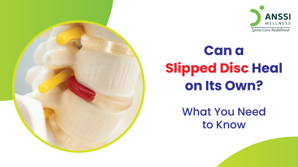 A slipped disc, also known as a herniated or prolapsed disc, is a common spinal condition that can cause significant discomfort, including back or neck pain.